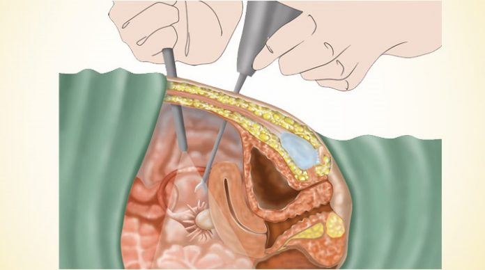 What is the removal of the uterus or hysterectomy