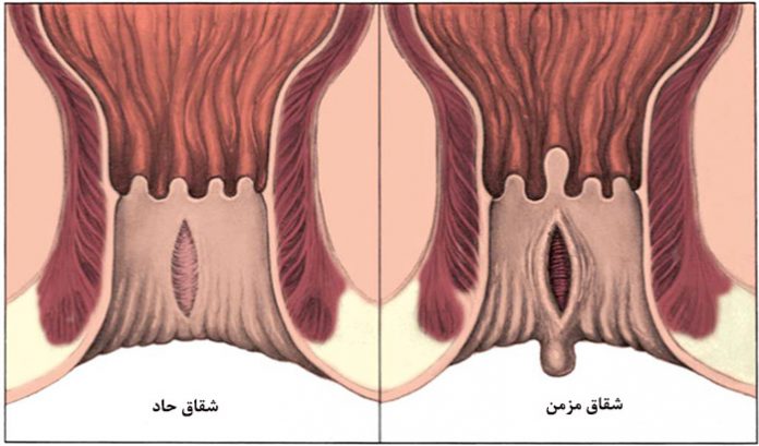 fissure-disease-and-treatment