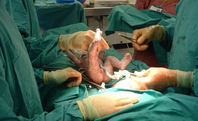 باورهای نادرست سزارینی