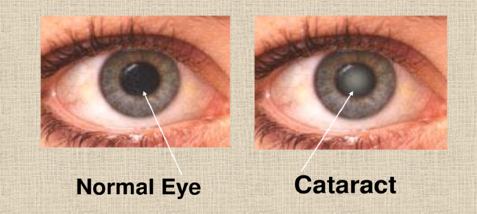 Complete information on cataracts