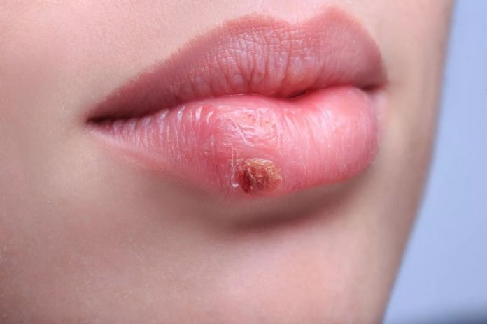 What is yellow wound and its treatment